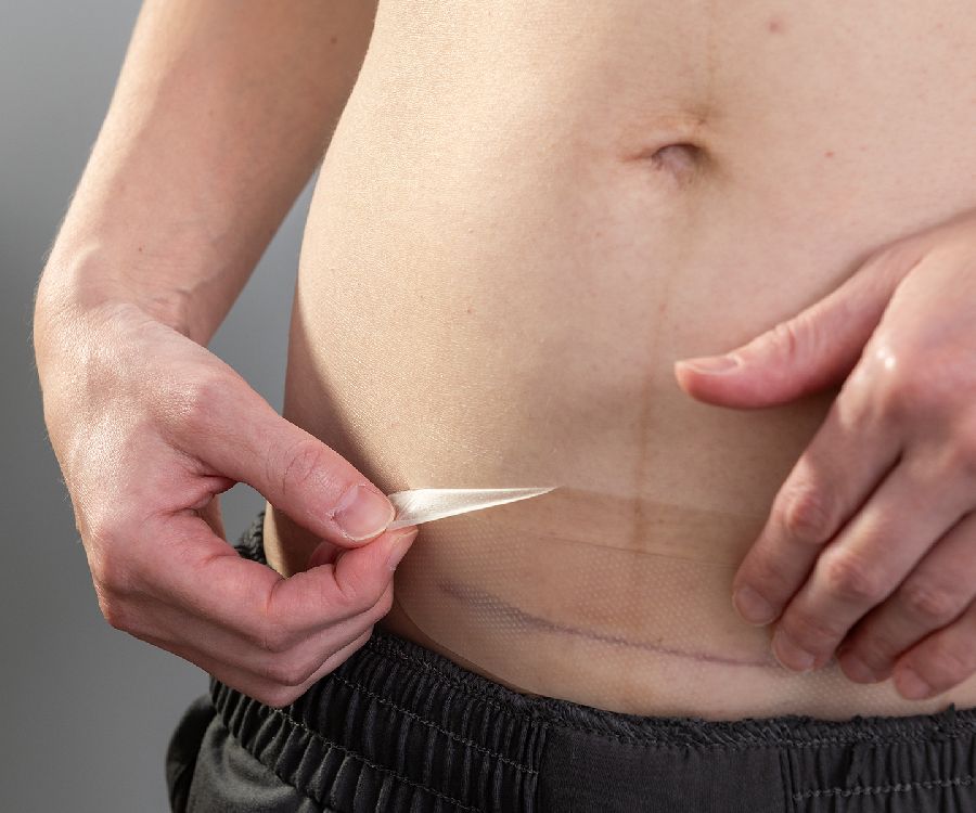 Na de bevalling Lansinoh Hydrogel keizersnede patch